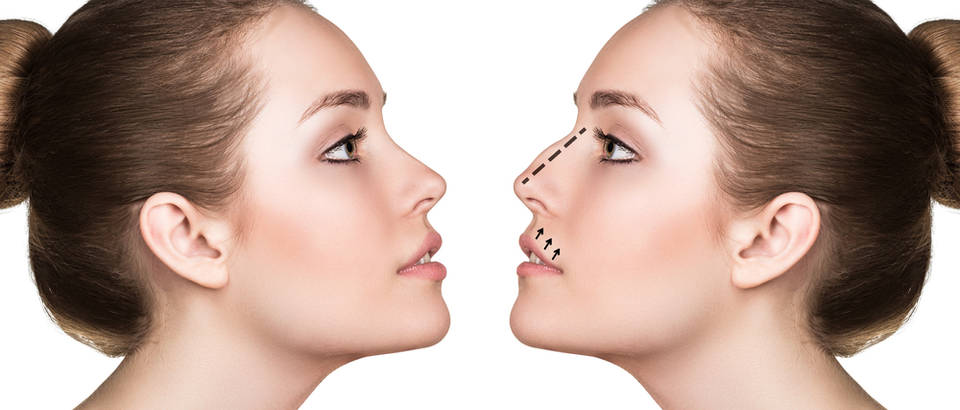 rinoplastia ultrasónica tunez